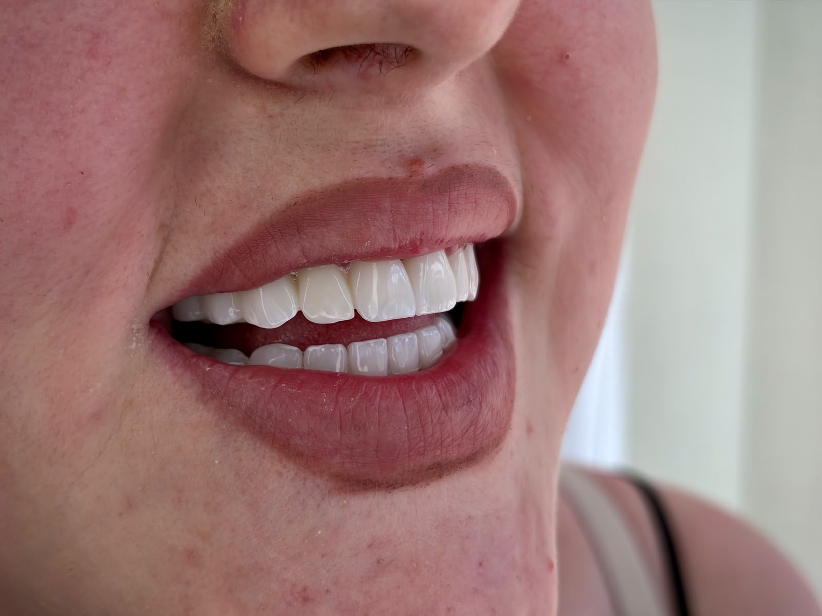 Transformim buzëqeshjeje - AS Dental