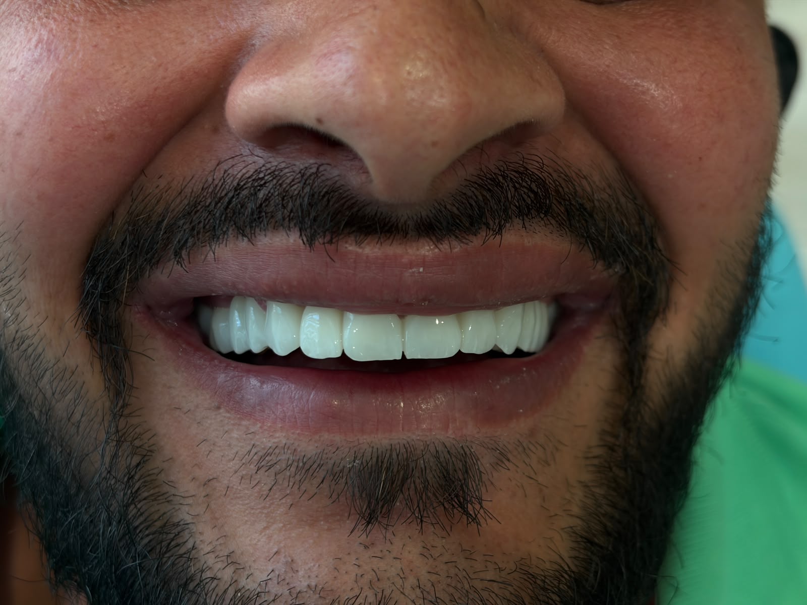 Transformim buzëqeshjeje - AS Dental