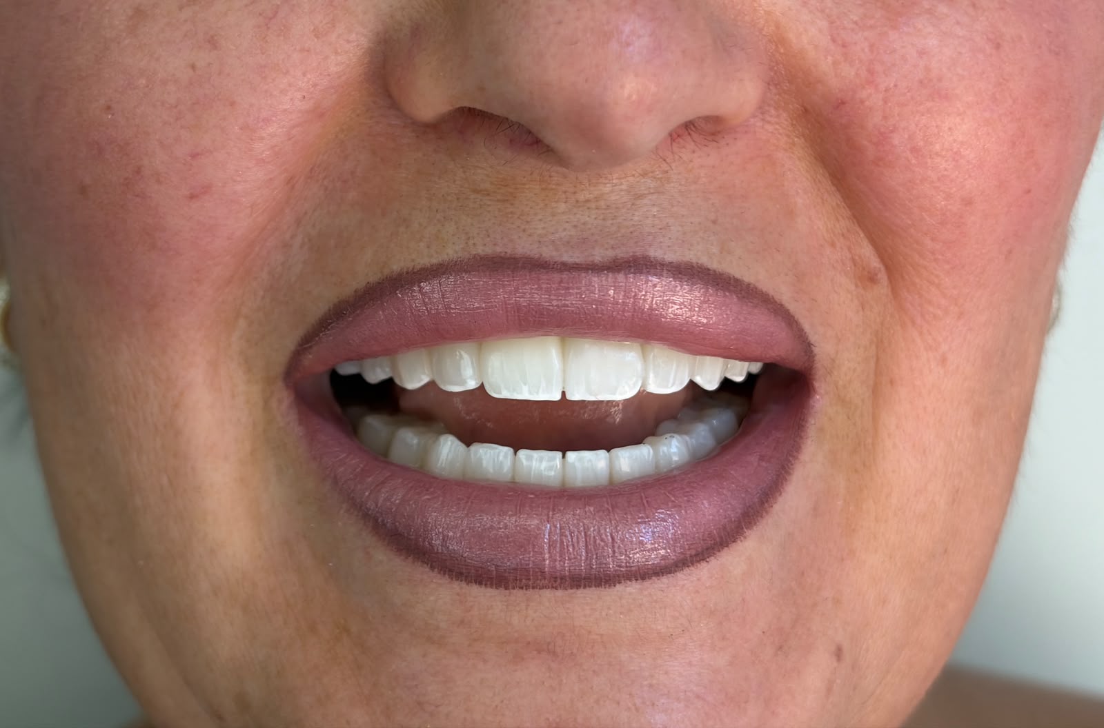 Transformim buzëqeshjeje - AS Dental