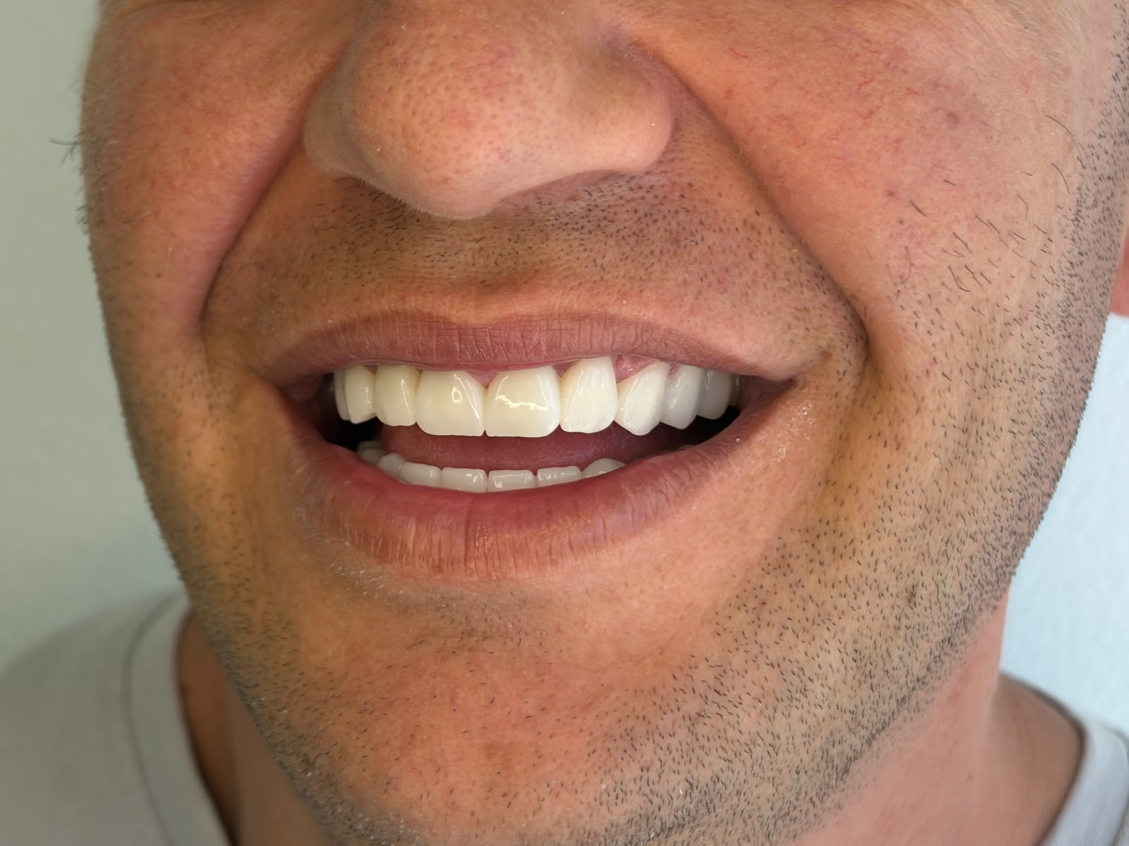 Transformim buzëqeshjeje - AS Dental