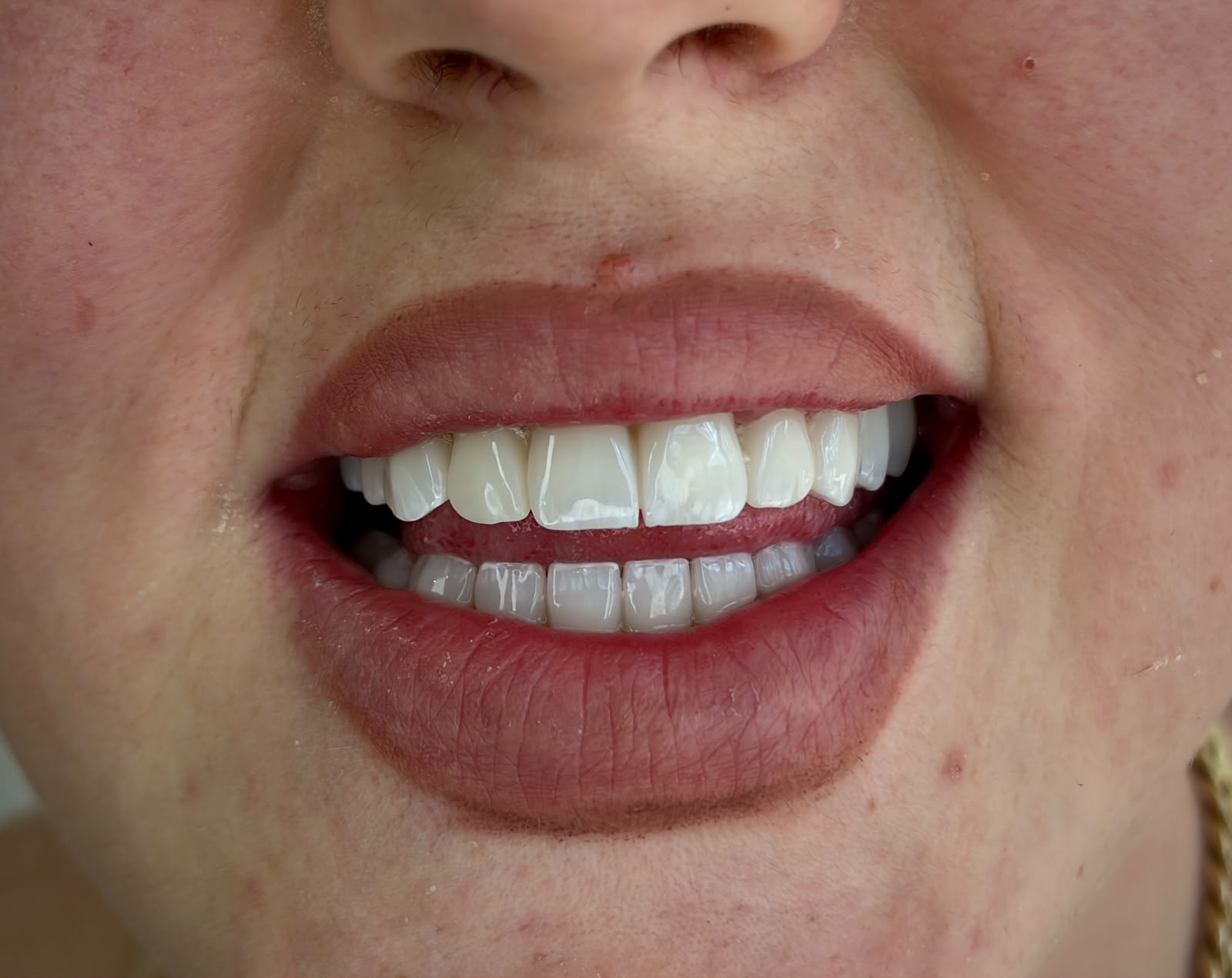 Transformim buzëqeshjeje - AS Dental