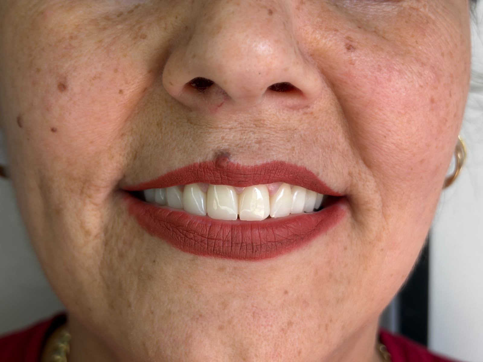 Transformim buzëqeshjeje - AS Dental