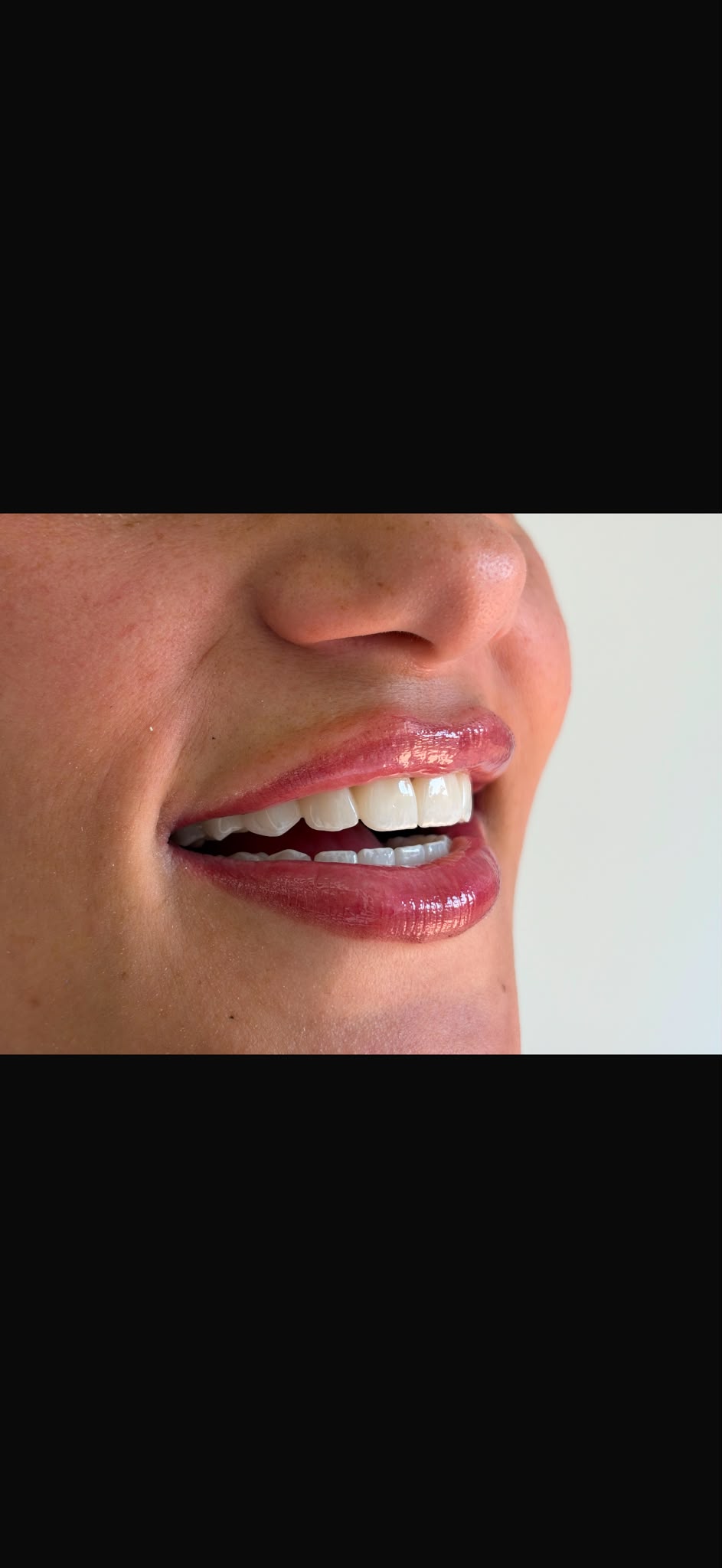 Transformim buzëqeshjeje - AS Dental