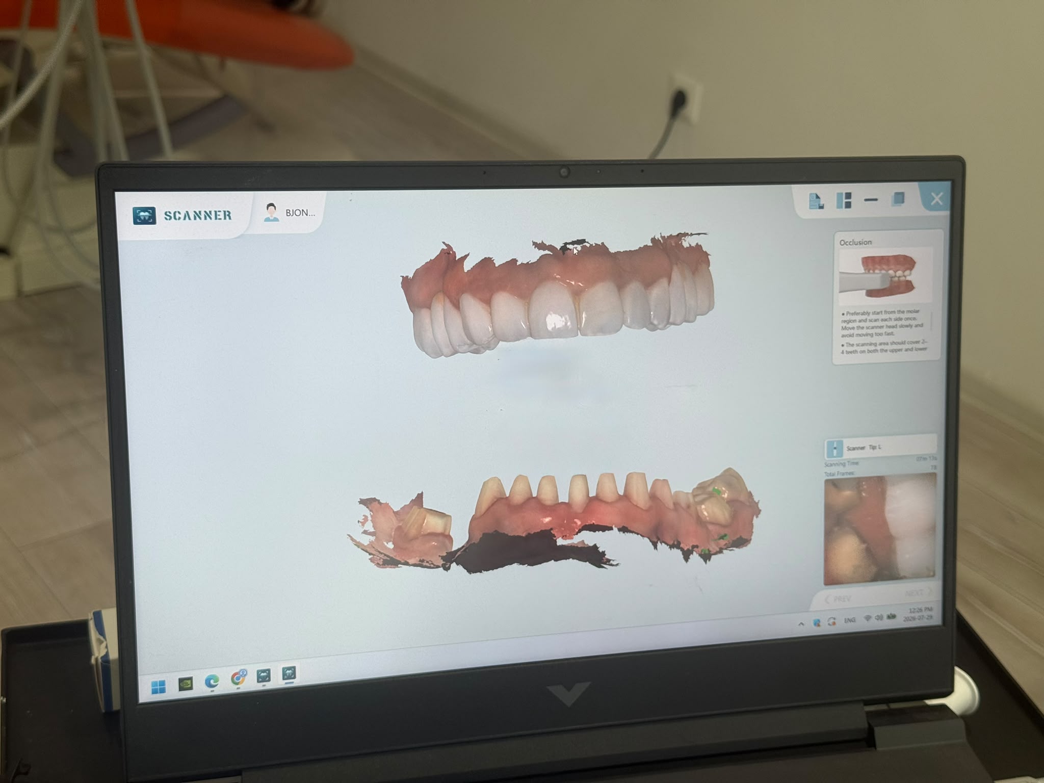 Intraoral 3D Scanner - AS Dental
